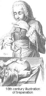 trepanation-illustration-18th-century