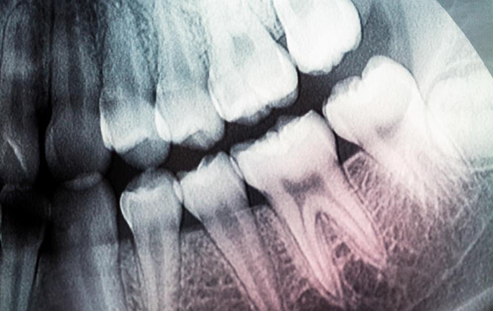 Научниците создадоа регенеративни забни пломби
