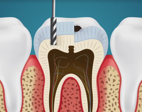 Видео: Како всушност изгледа пломбирање на заб, во забот