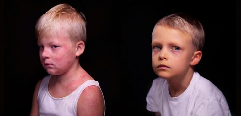 Како ќе изгледаат децата ако се вратат болестите што се искоренети со вакцини (галерија)